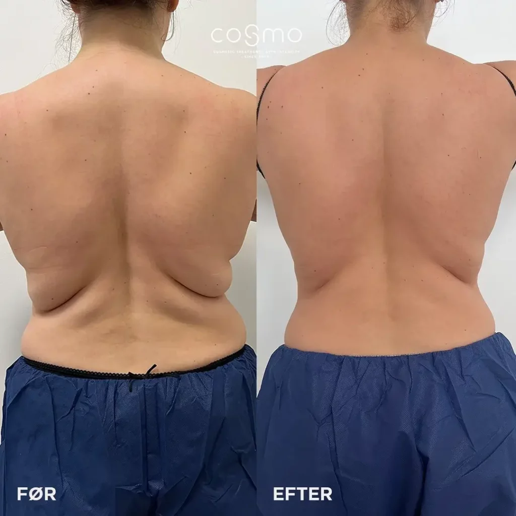 CoolSculpting Before and After