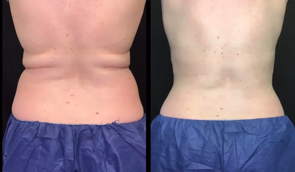 CoolSculpting Before and After