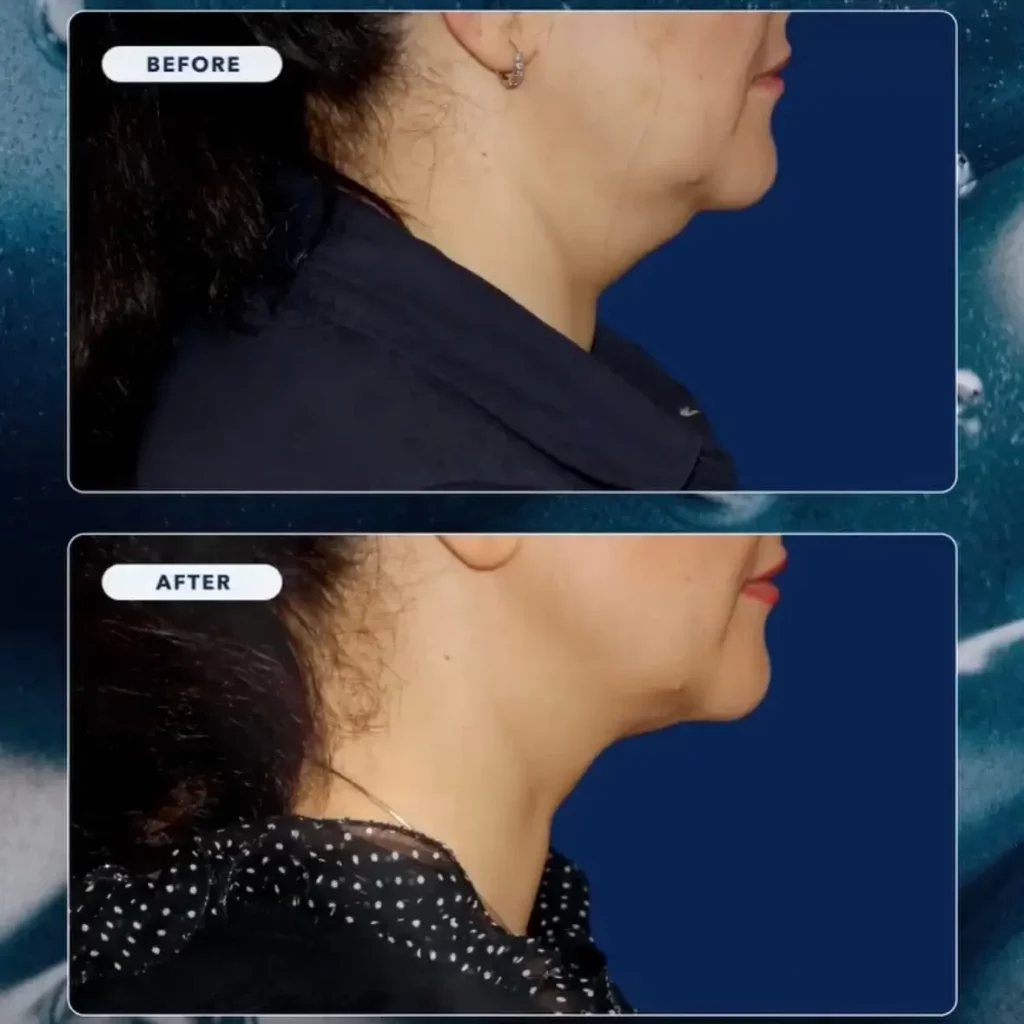 CoolSculpting Before and After