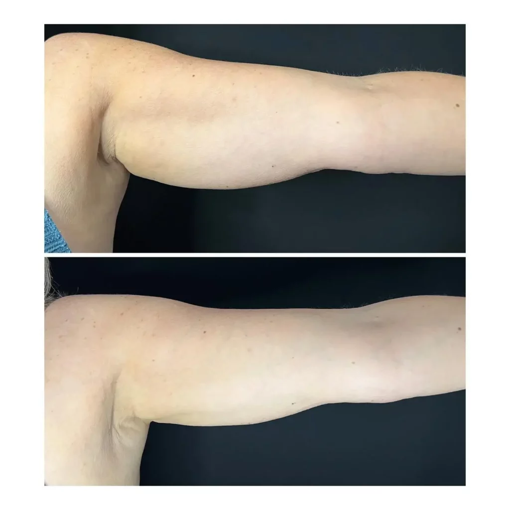 CoolSculpting Before and After