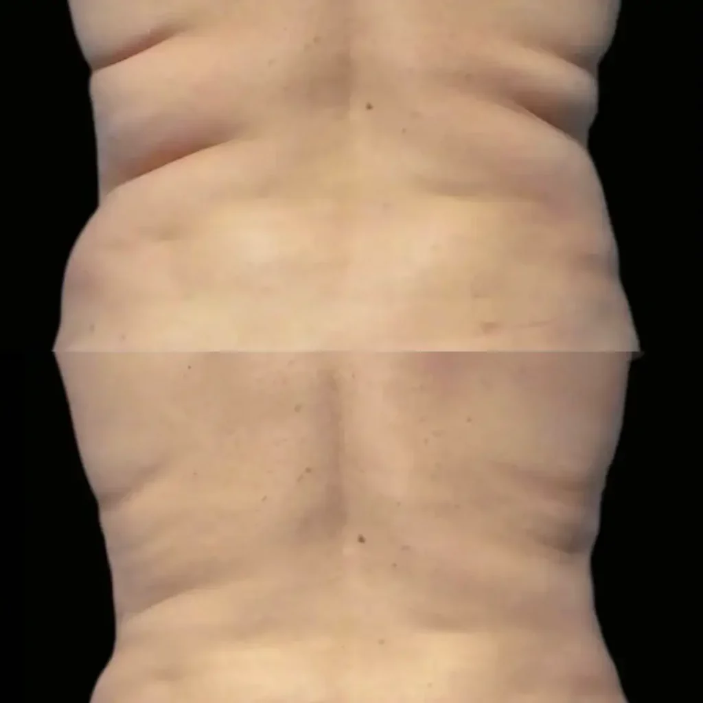 CoolSculpting Before and After