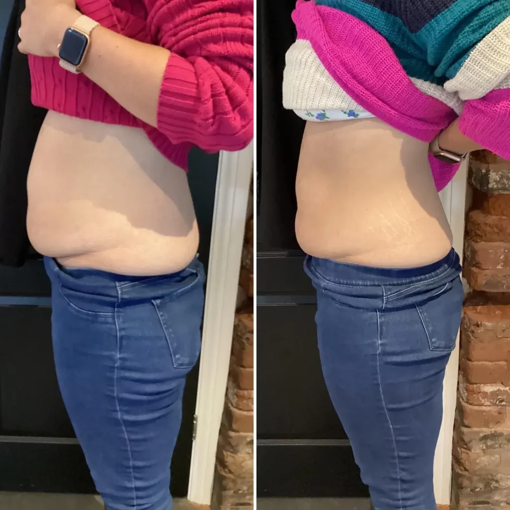 CoolSculpting Before and After