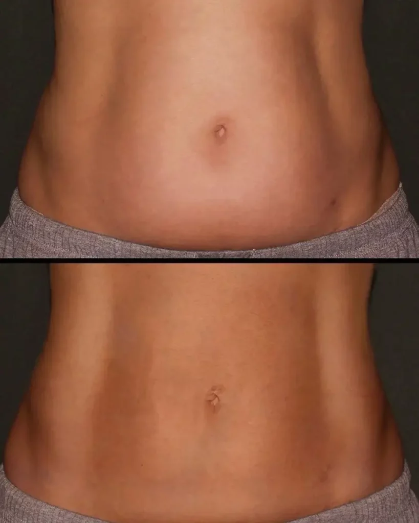 CoolSculpting Before and After