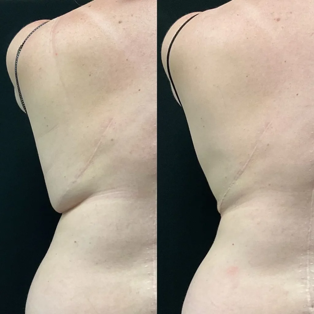 CoolSculpting Before and After