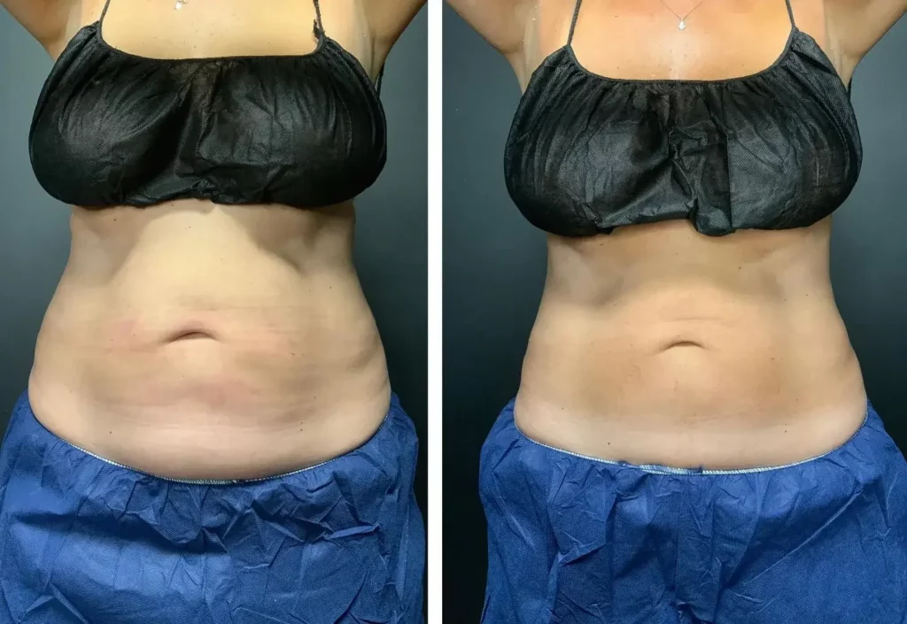 CoolSculpting Before and After