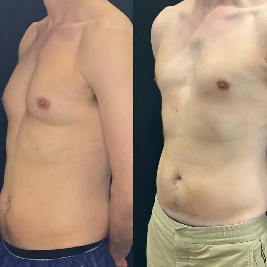 CoolSculpting Before and After