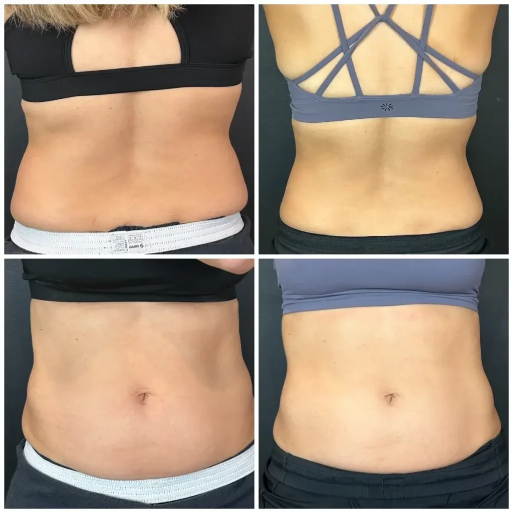 CoolSculpting Before and After