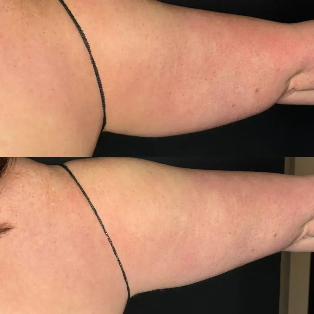 CoolSculpting Before and After