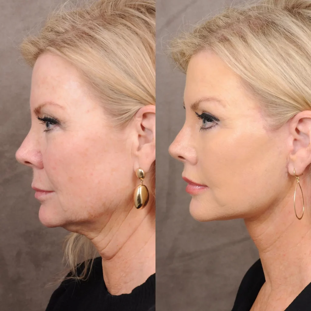 Facelift before and after