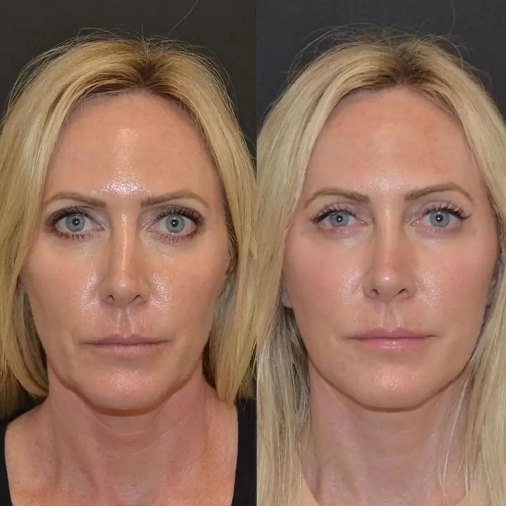 Facelift Before and After