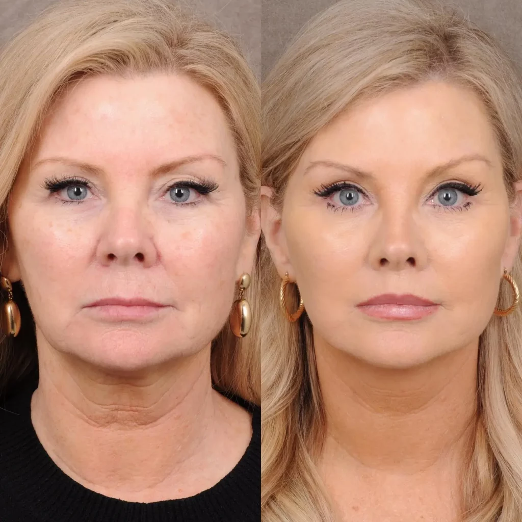 Facelift Before and After