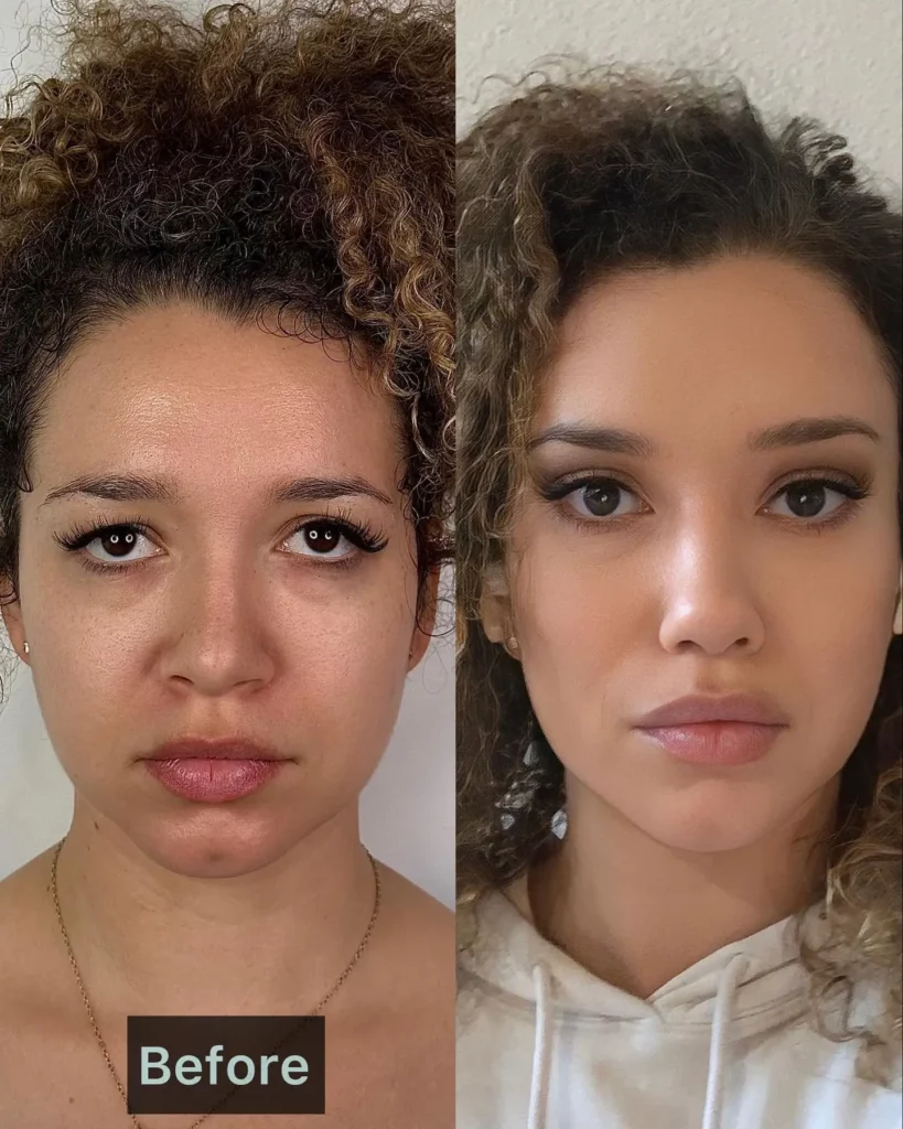 Facelift Before and After