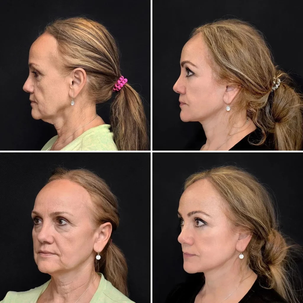 Facelift Before and After