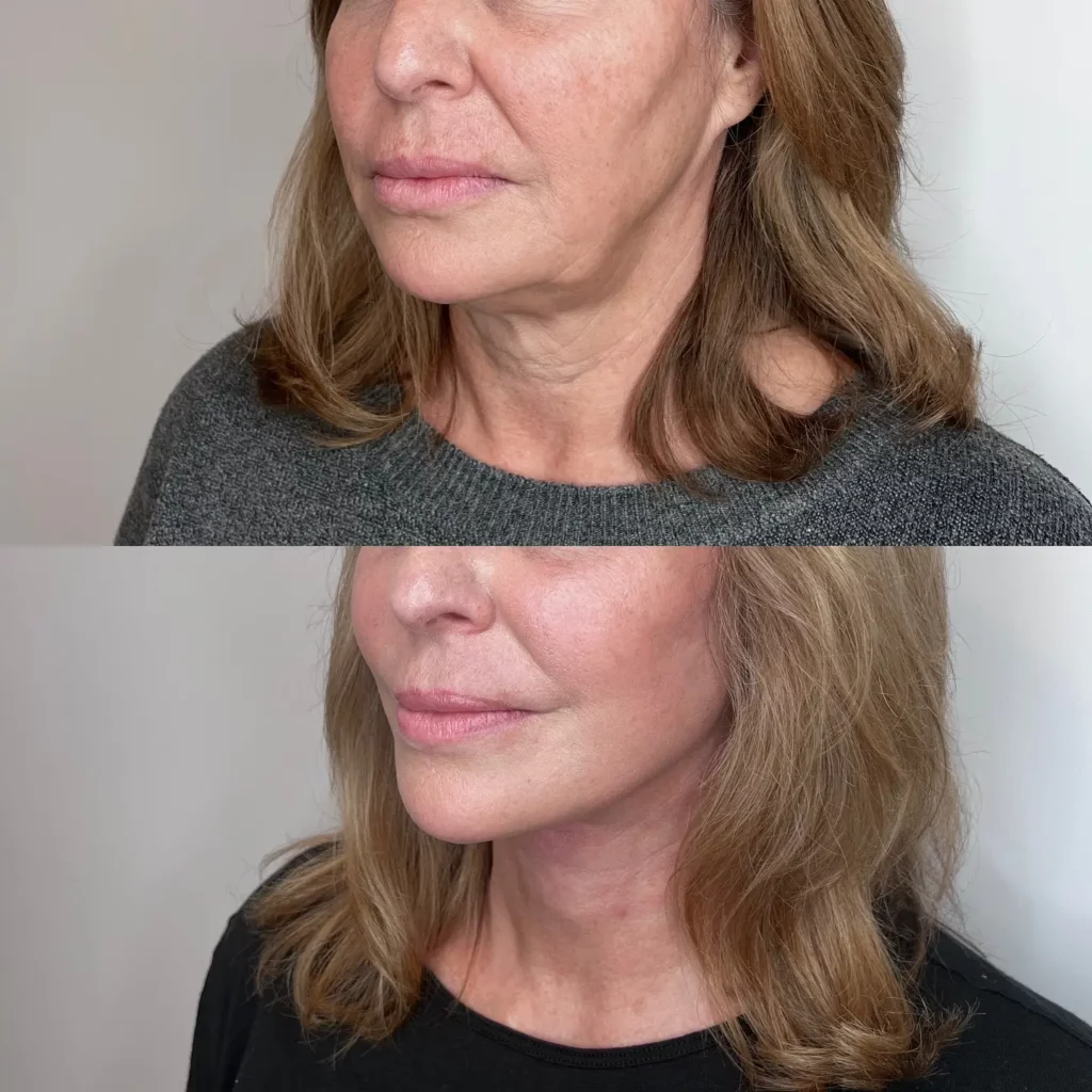 Facelift Before and After