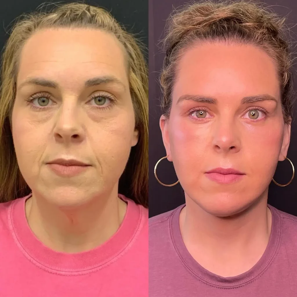 Facelift Before and After