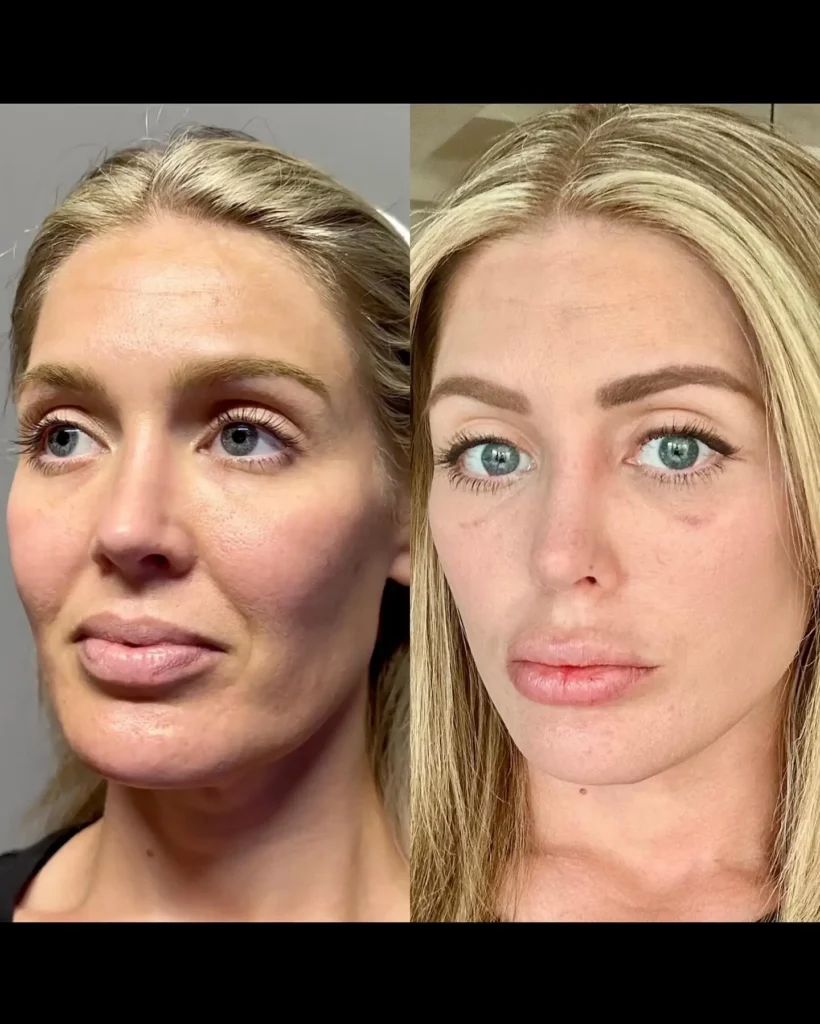 Facelift Before and After