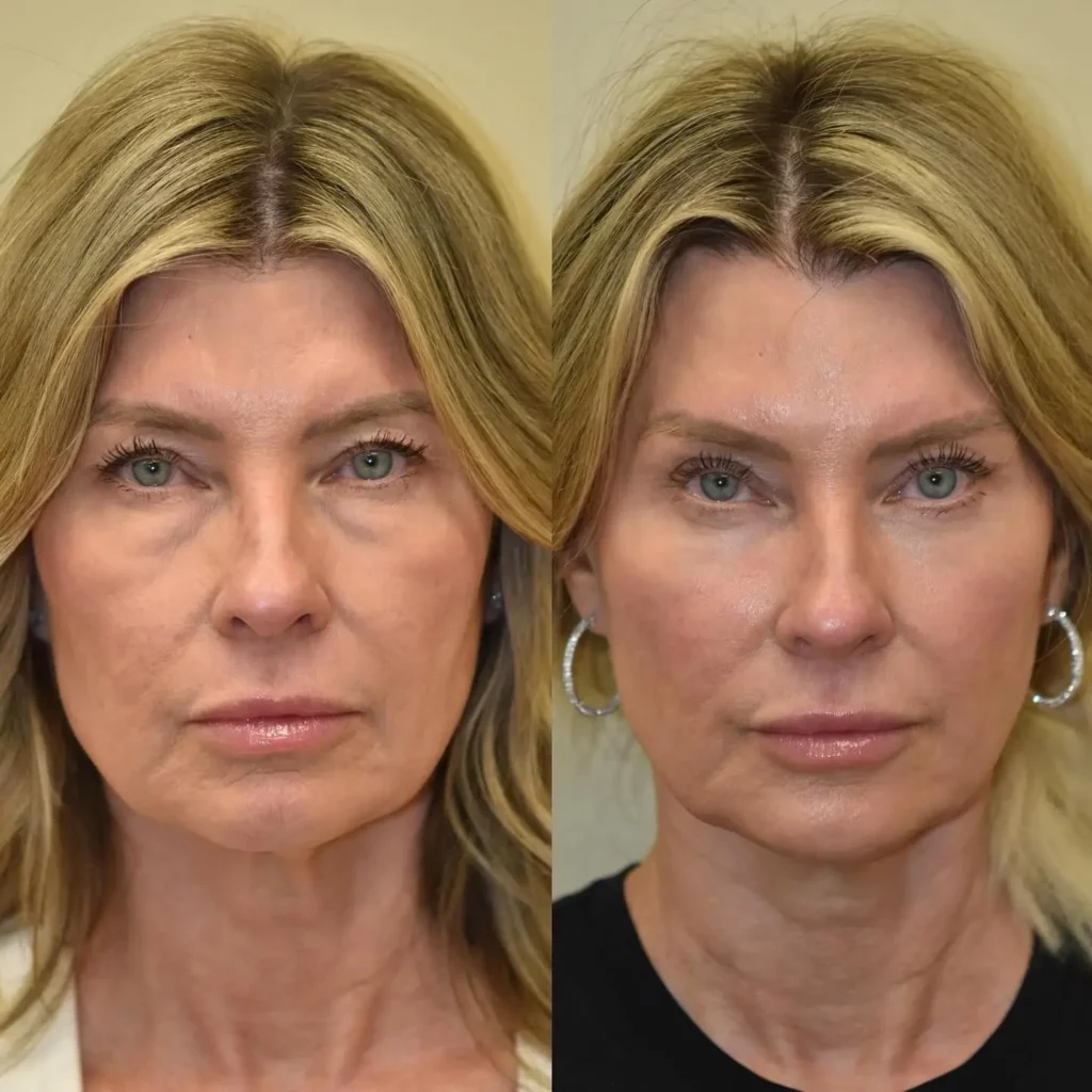 Facelift Before and After