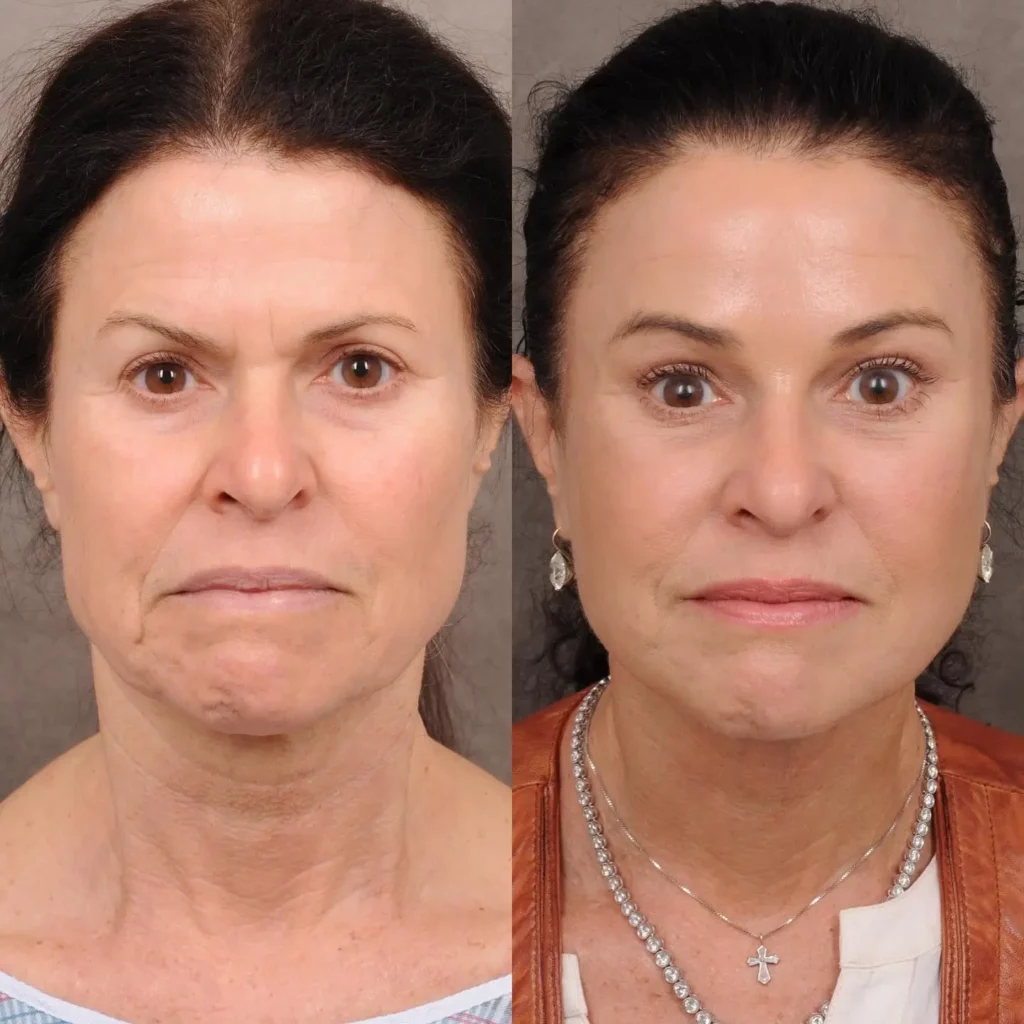 Facelift Before and After