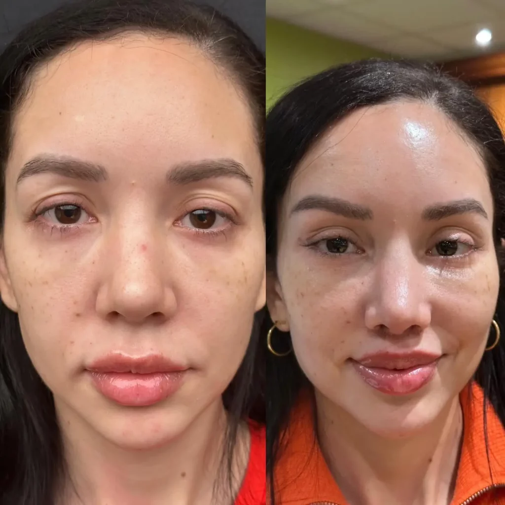 Facelift Before and After