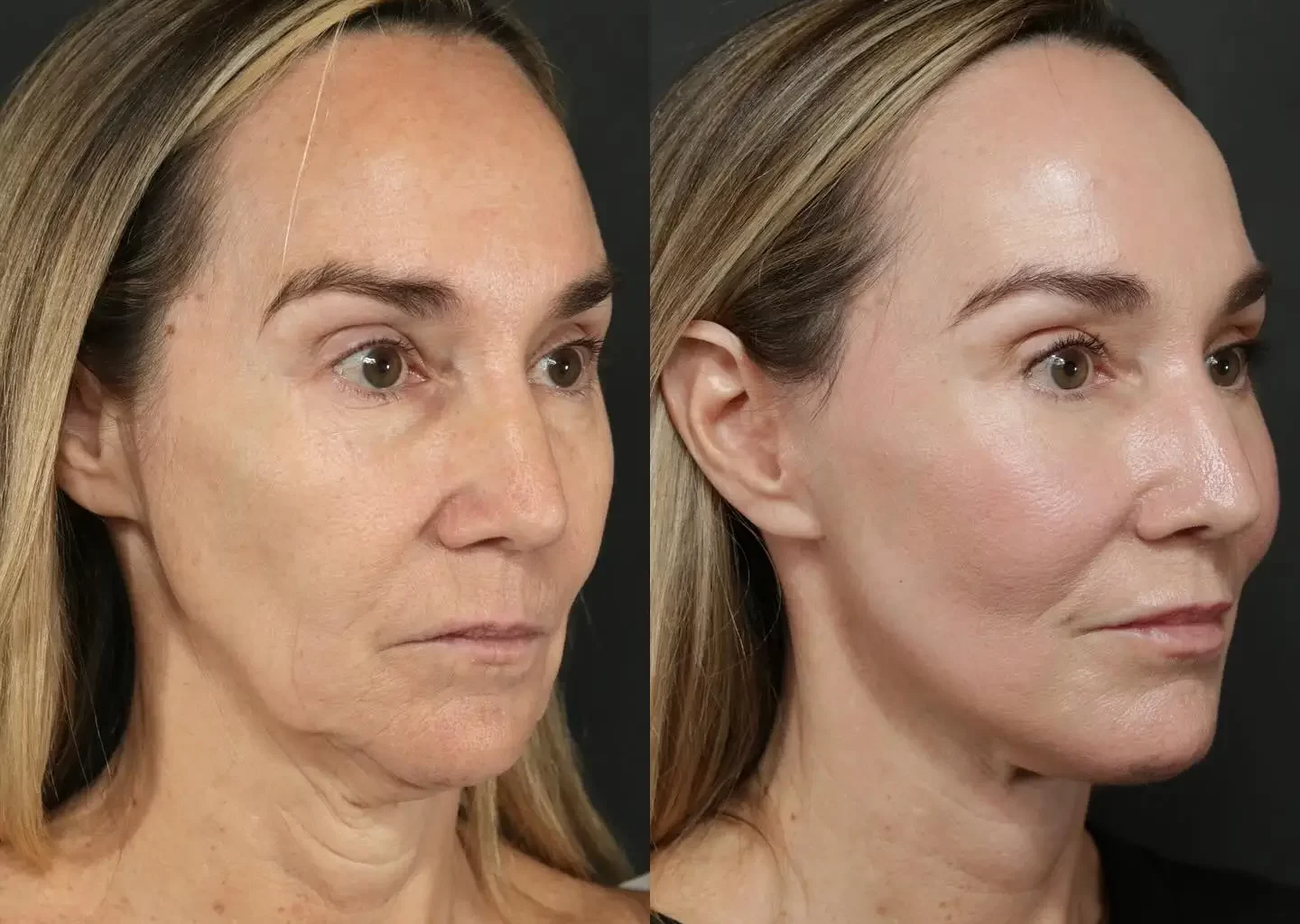 Facelift Before and After