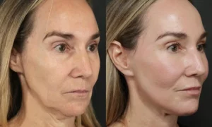 Facelift Before and After