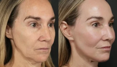 Facelift Before and After