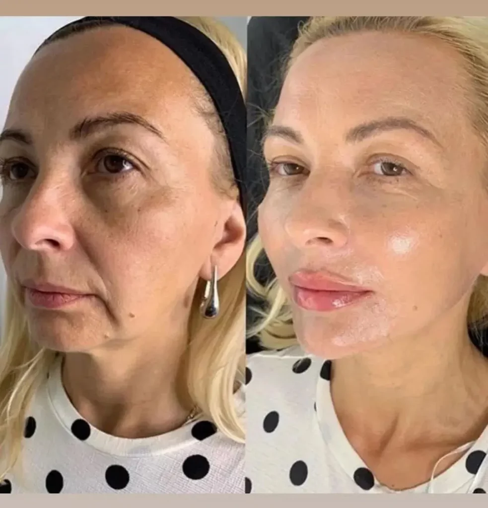 Facelift Before and After