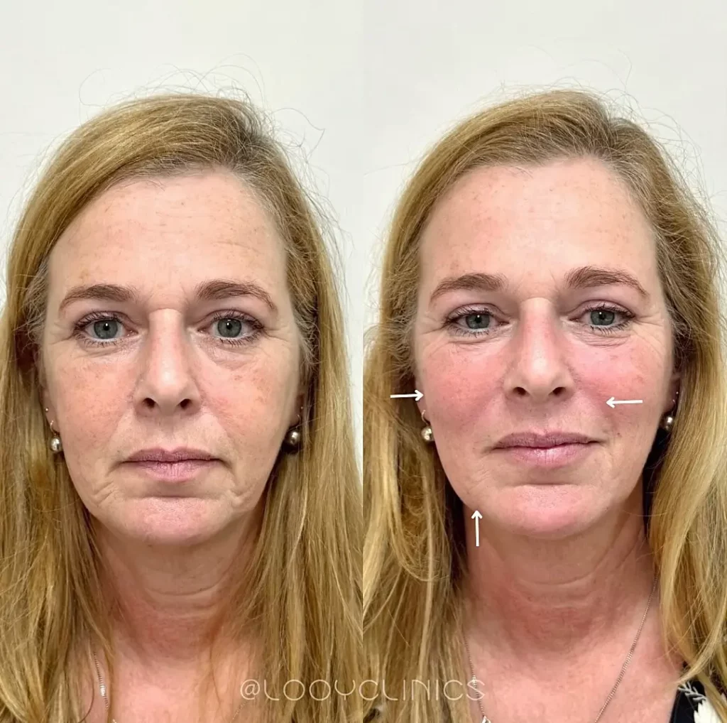 Facelift Before and After