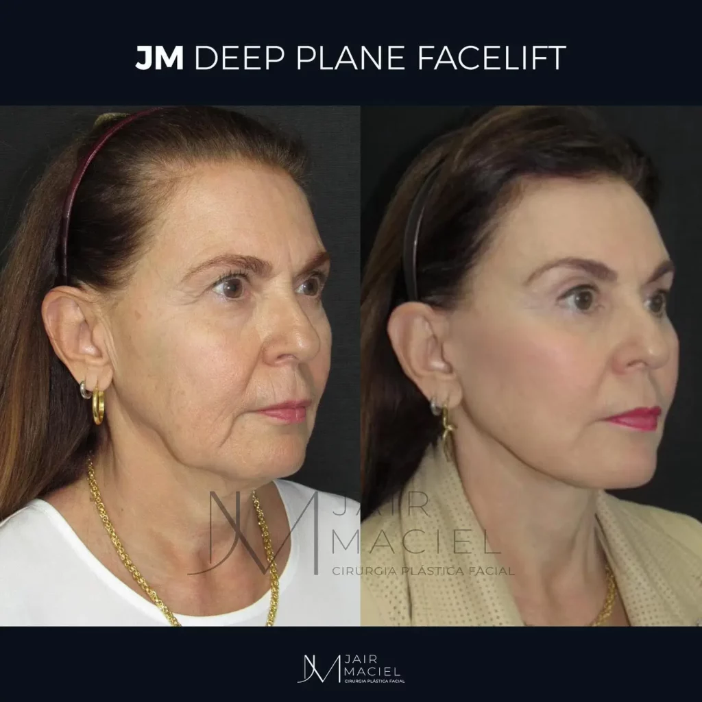 Facelift Before and After