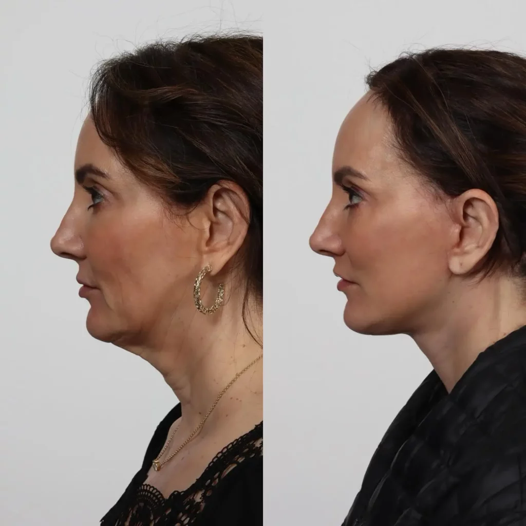 Facelift Before and After