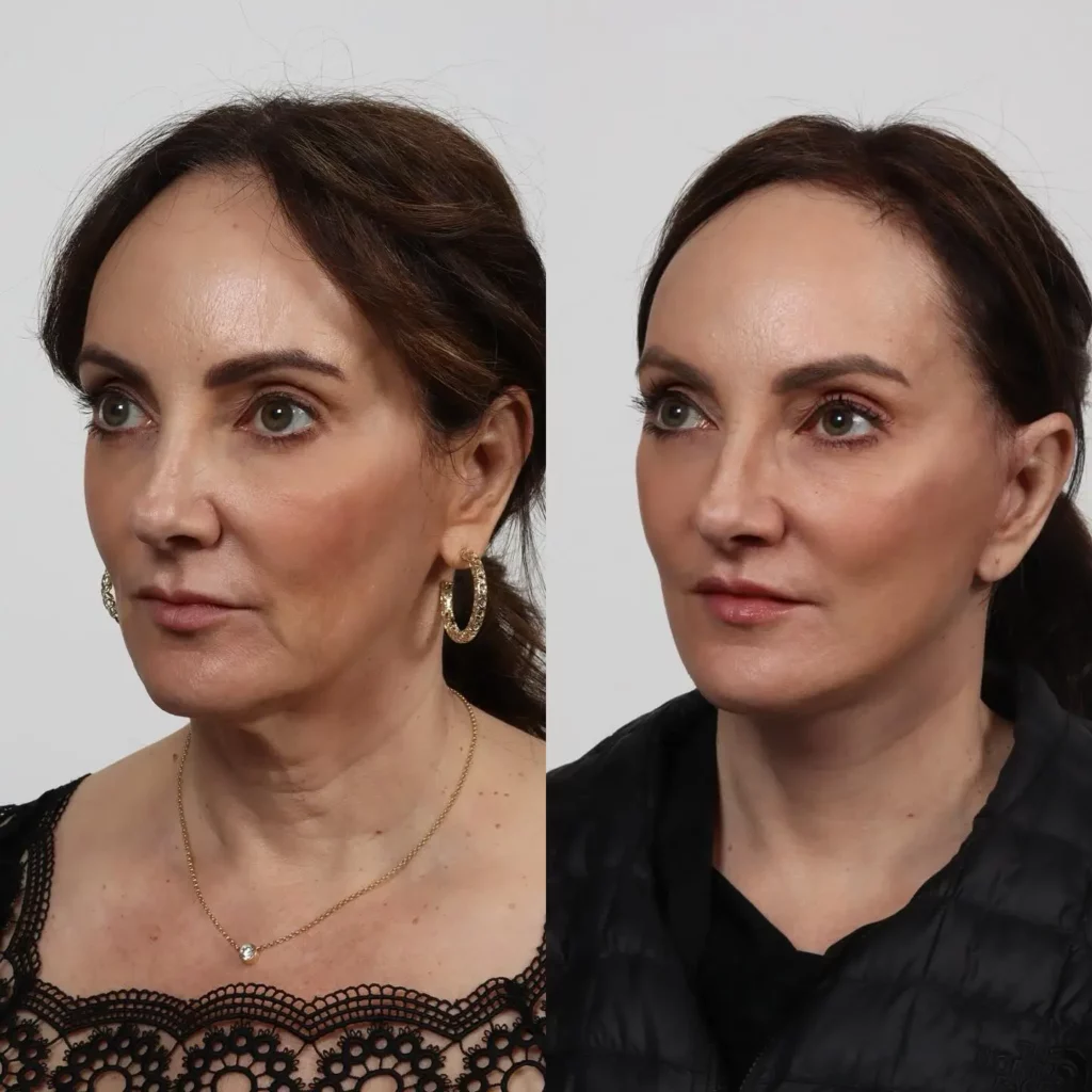 Facelift Before and After