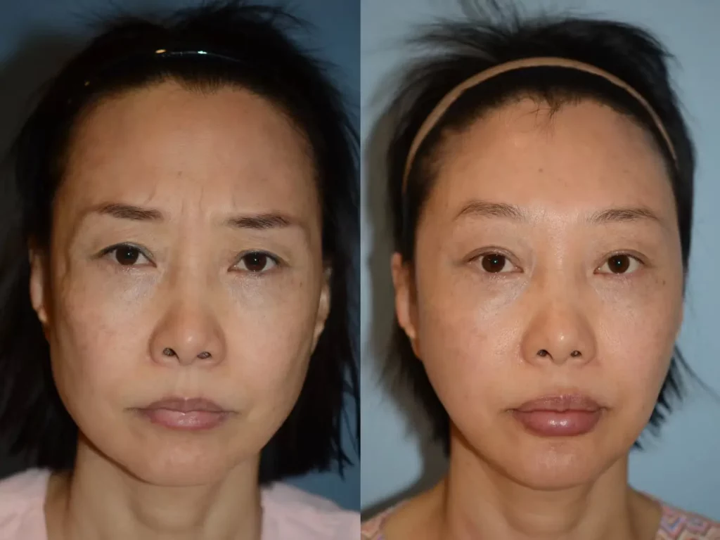 Facelift Before and After