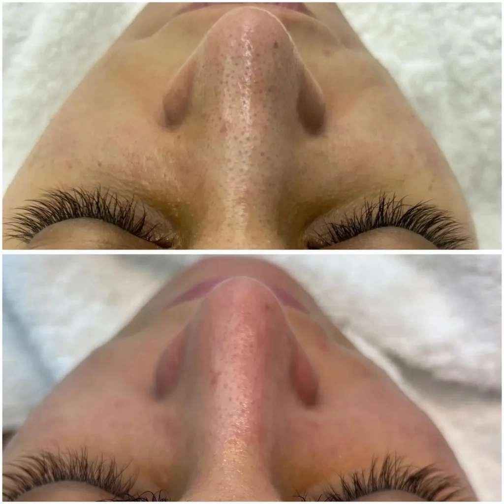 Hydrafacial Before and After