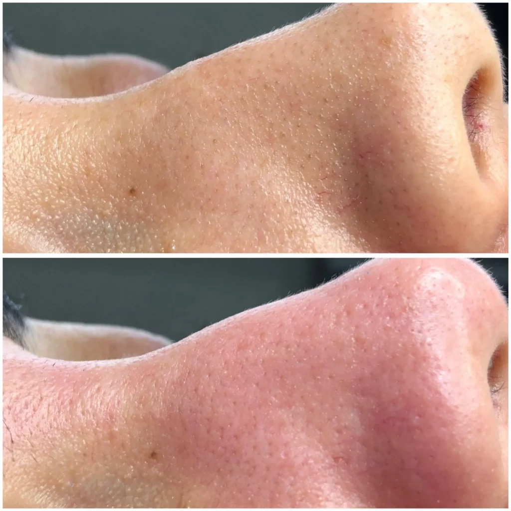 Hydrafacial Before and After