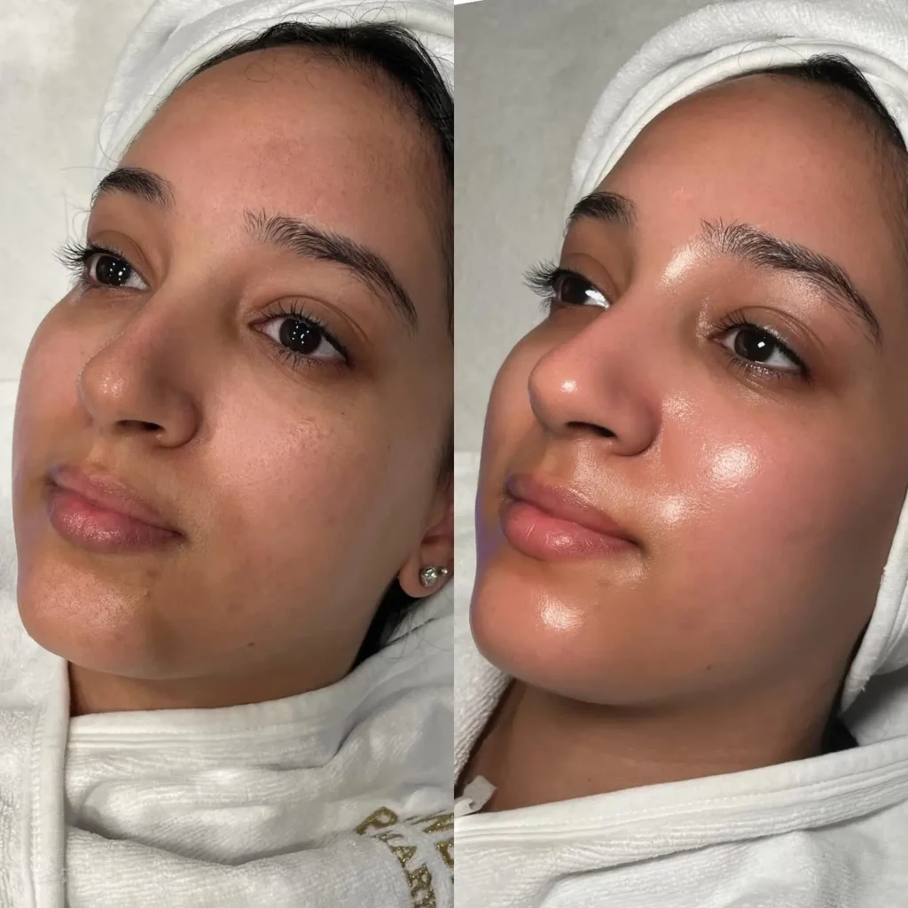 Hydrafacial Before and After