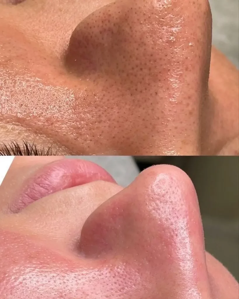 Hydrafacial Before and After