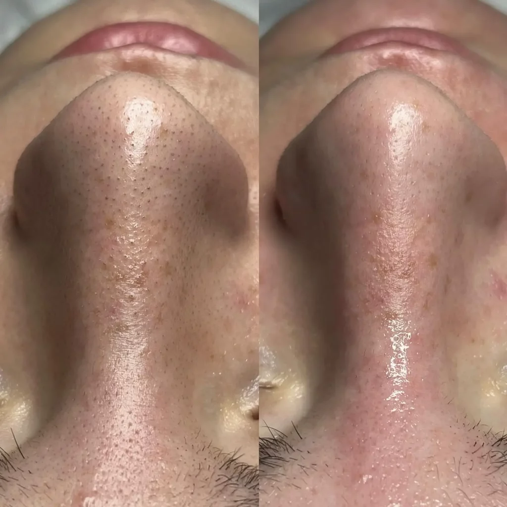 Hydrafacial Before and After