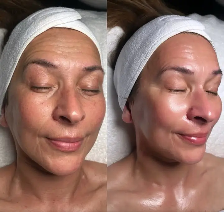 Hydrafacial Before and After