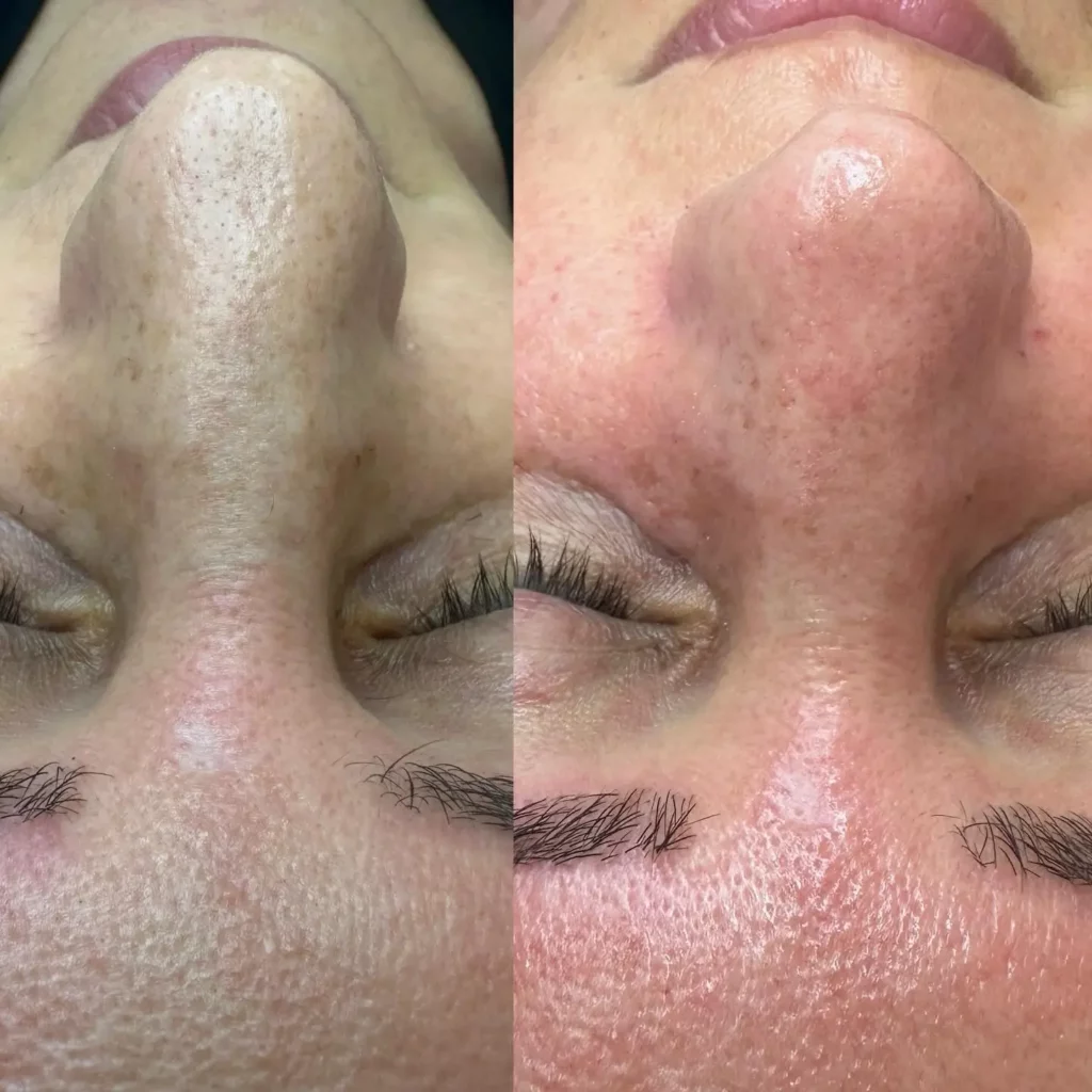 Hydrafacial Before and After