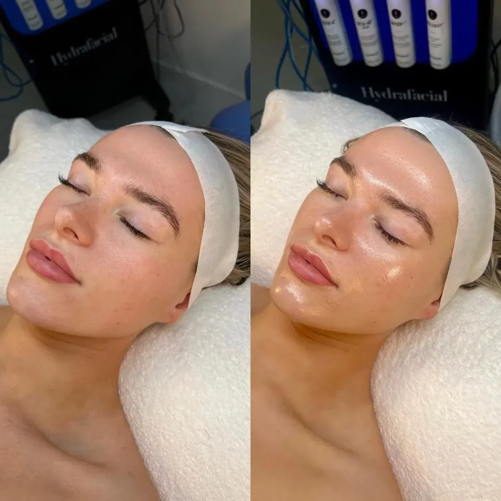 Hydrafacial Before and After