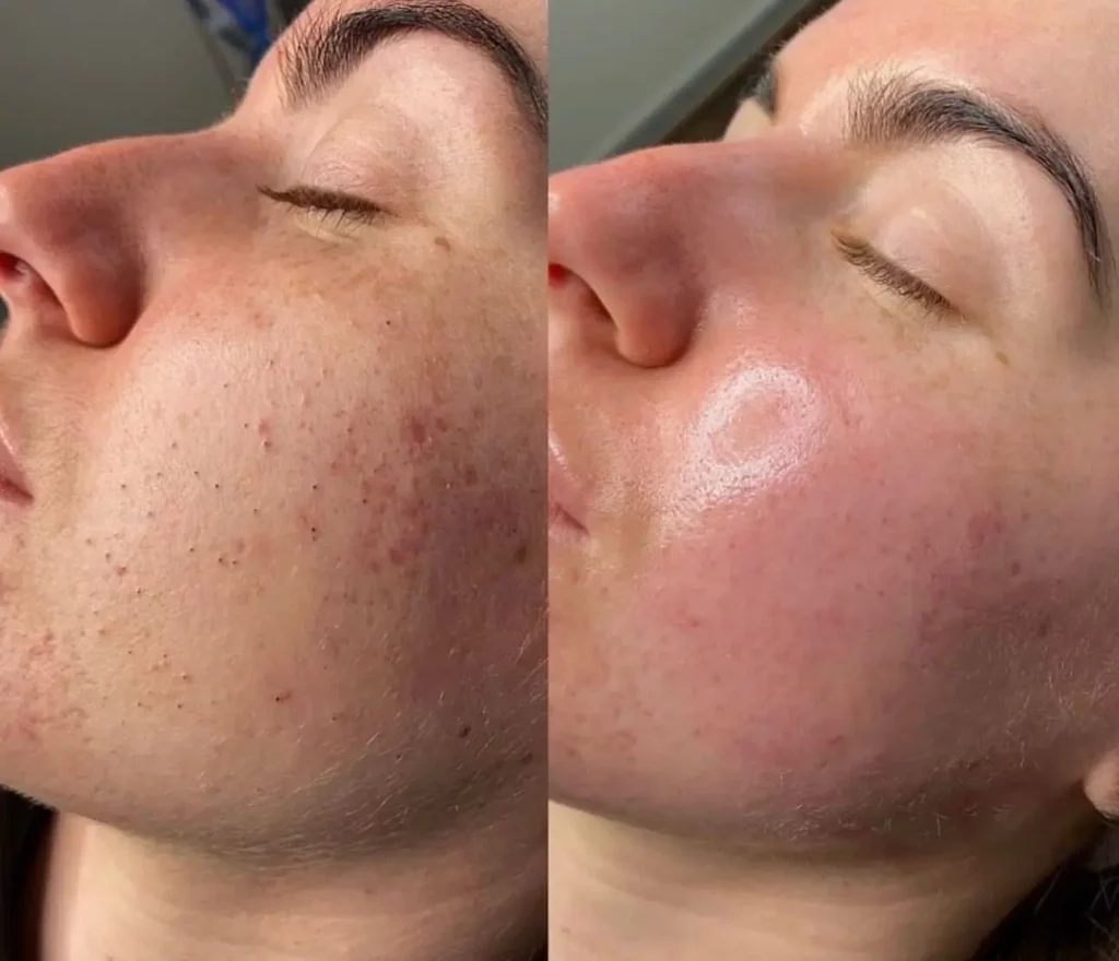 Hydrafacial Before and After