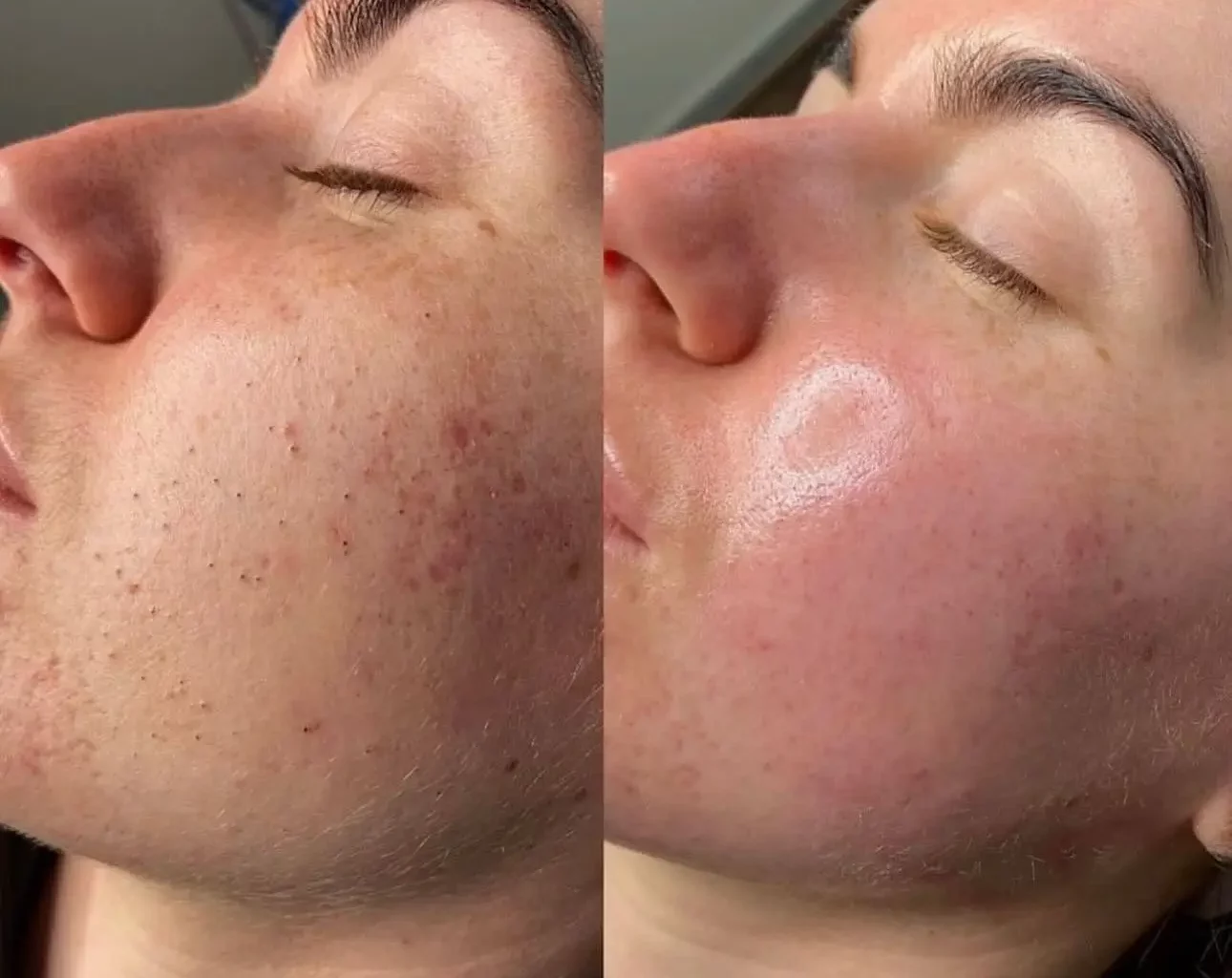 Hydrafacial Before and After