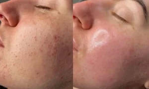 Hydrafacial Before and After