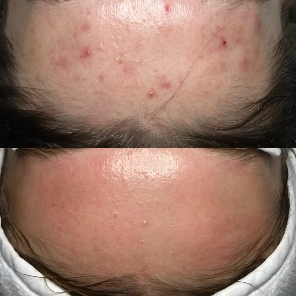 Hydrafacial Before and After