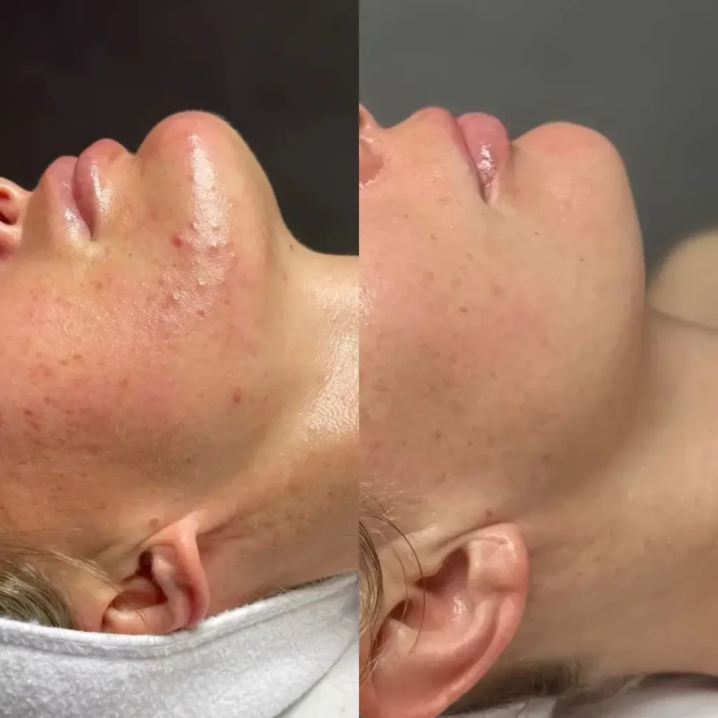 Hydrafacial Before and After