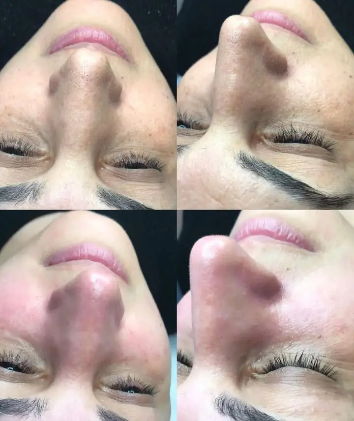 Hydrafacial Before and After