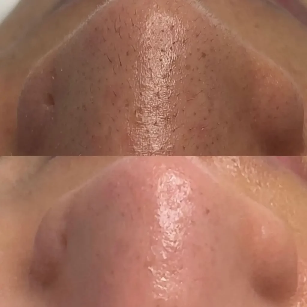 Hydrafacial Before and After