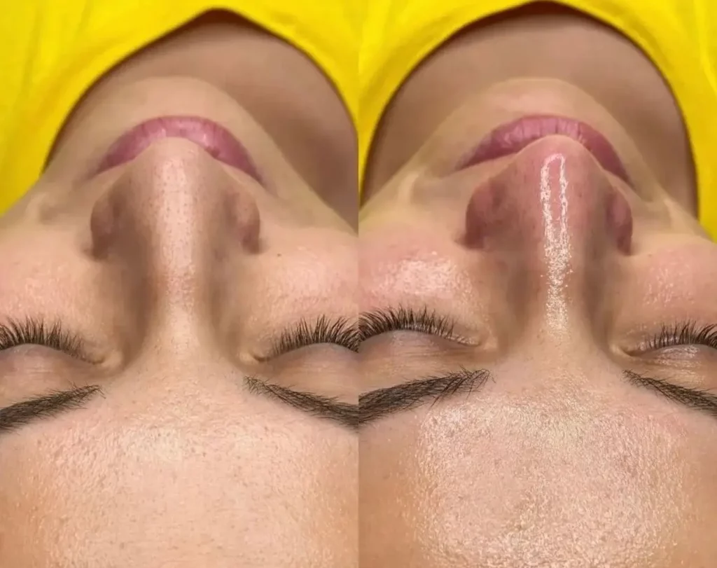 Hydrafacial Before and After