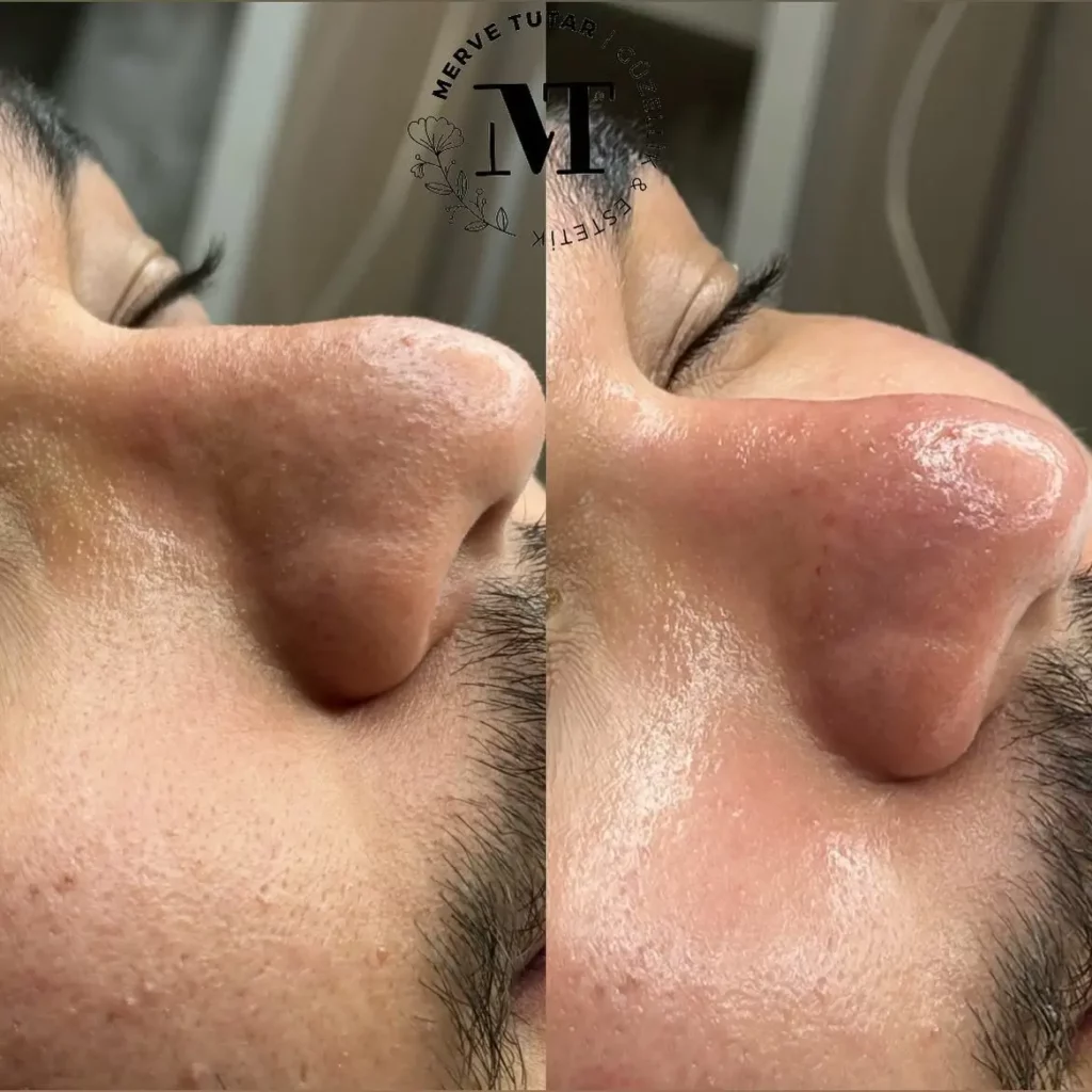 Hydrafacial Before and After