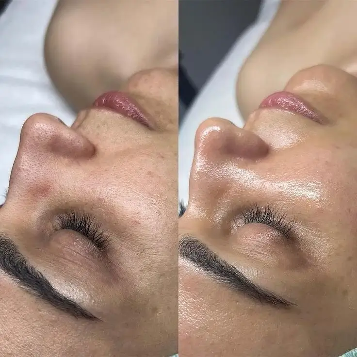 Hydrafacial Before and After